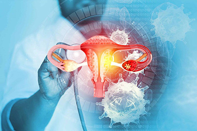 SMART PREVENTION OF CANCER IN GYNECOLOGY